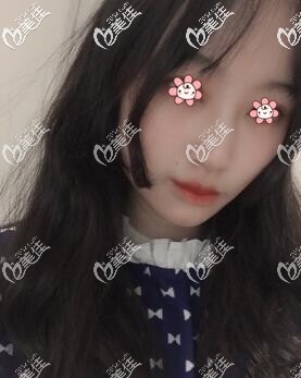 做了厚唇改薄還會(huì)再長(zhǎng)厚嗎？反正我在貴州這家醫(yī)院做的好著也不貴