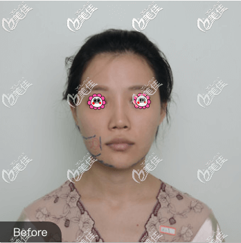 做不開刀去下頜角前 做不開刀去下頜角前