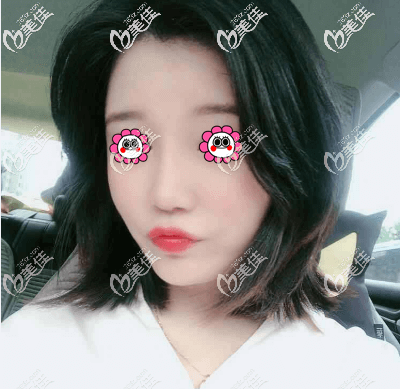 我找王東做不開刀磨骨改臉型半個(gè)月 我找王東做不開刀磨骨改臉型半個(gè)月