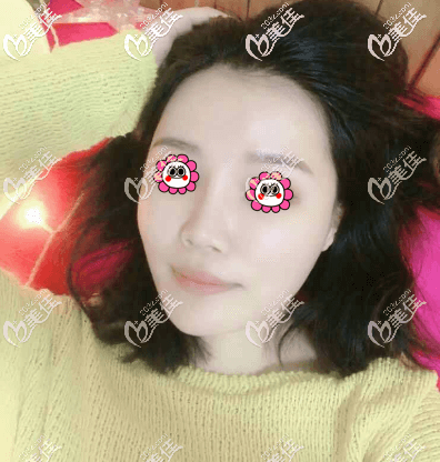 我在北京藝美做不開刀縮下頜角30天 我在北京藝美做不開刀縮下頜角30天