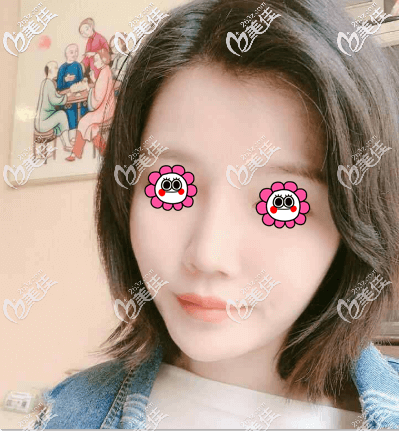 北京藝美王東不開刀去下頜角案例效果 北京藝美王東不開刀去下頜角案例效果