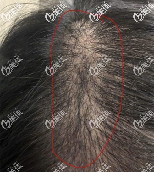 頭發(fā)加密種植1500單位圖片