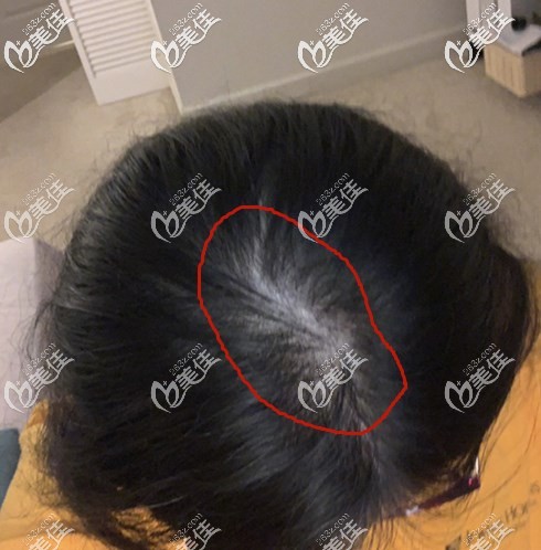 寧波薇琳植發(fā)醫(yī)院好不好?我這個(gè)做過頭發(fā)稀疏加密的人還是比較有發(fā)言權(quán)的!