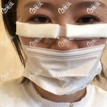 割眼袋后不用住院 割眼袋后不用住院