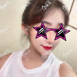 埋線提升術(shù)后30天拉扯感漸消 埋線提升術(shù)后30天拉扯感漸消