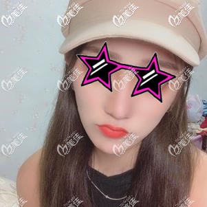 做了面部埋線提升手術(shù)后臉疼是正?，F(xiàn)象嗎？以我過來人的身份給你們說說