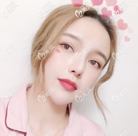 找廣州美萊張毓做的面部吸脂效果特別好,術(shù)后一年沒有反彈也沒有下垂拍照更上鏡了