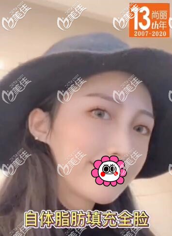 自體脂肪填充面部3個月內(nèi)不能笑是因?yàn)闀绊懼敬婊盥屎笥绊懟謴?fù)效果