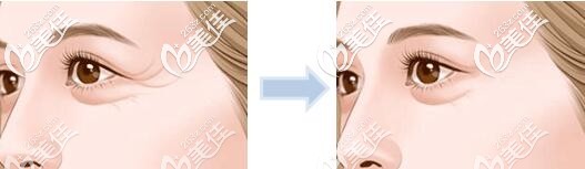 眼尾提升術(shù)效果 眼尾提升術(shù)效果