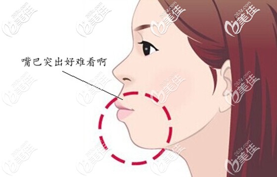 女朋友的輕微齙牙好難看