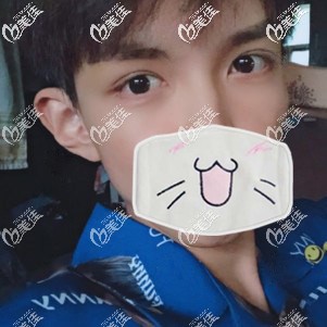 植眉術(shù)后7天效果圖