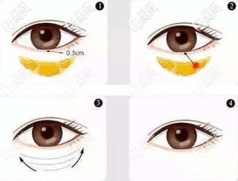 不開刀怎么去眼袋從技術(shù)原理來了解