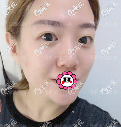 在北京去眼袋正規(guī)醫(yī)院紫潔醫(yī)美做不開刀祛眼袋一周了