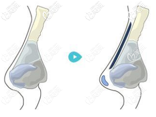 自體軟墊鼻頭 自體軟墊鼻頭