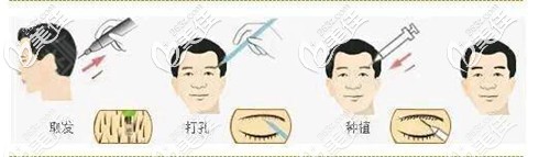 眉毛種植手術(shù)原理解析圖