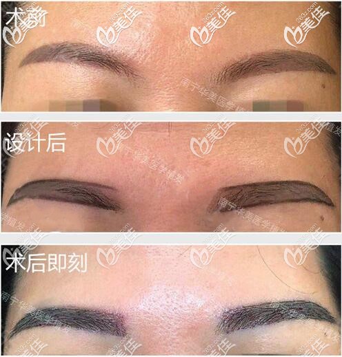 眉毛種植術(shù)前術(shù)后即刻對(duì)比照片
