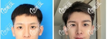 南寧華美眉毛種植效果圖