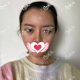 割雙眼皮術(shù)后第2天效果照 割雙眼皮術(shù)后第2天效果照