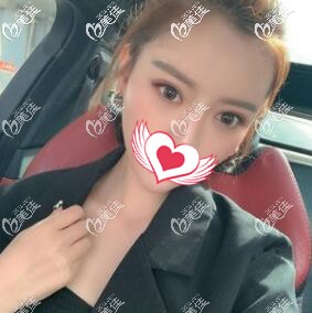 星妍10度美眼術(shù)后20天效果照 星妍10度美眼術(shù)后20天效果照