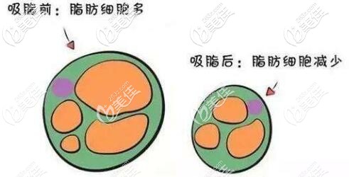 吸脂是直接抽走了身體里的脂肪細(xì)胞，使得脂肪細(xì)胞數(shù)量減少