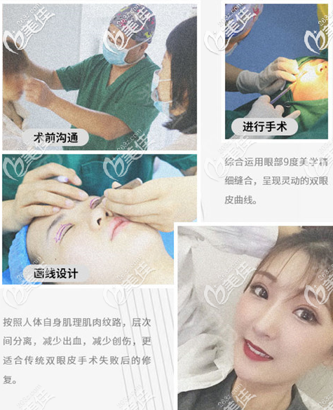 東莞壹加壹張永新醫(yī)生雙眼皮手術(shù)過(guò)程案例效果圖