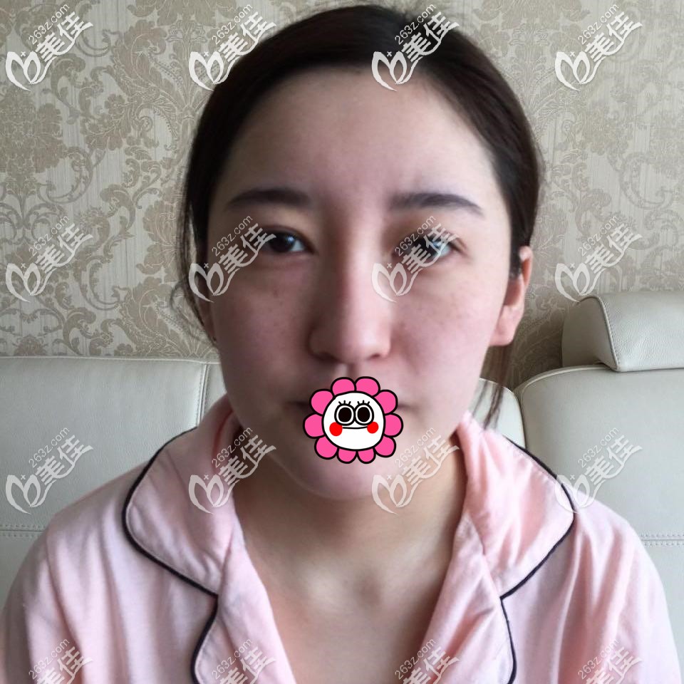 做假體隆鼻前 做假體隆鼻前