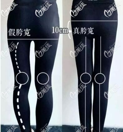 假胯形成原因 假胯形成原因