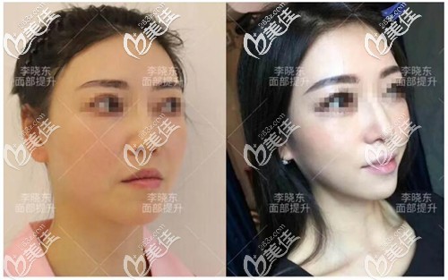 李曉東醫(yī)生pst面部提升案例