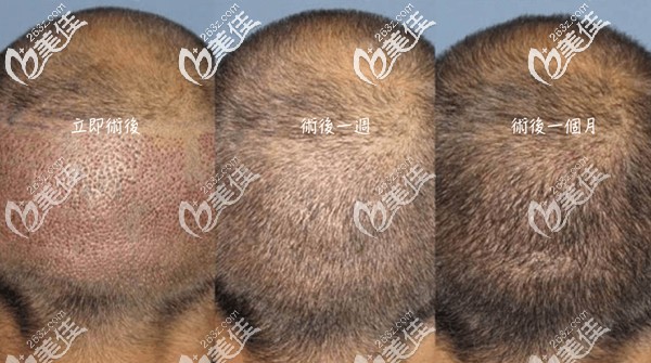 植發(fā)后后枕部的恢復(fù)過程圖