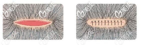 FUT植發(fā)手術(shù)會(huì)在后枕部留疤