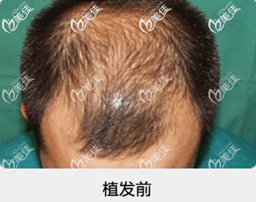 頭頂種植術(shù)前脫發(fā)面積圖 頭頂種植術(shù)前脫發(fā)面積圖