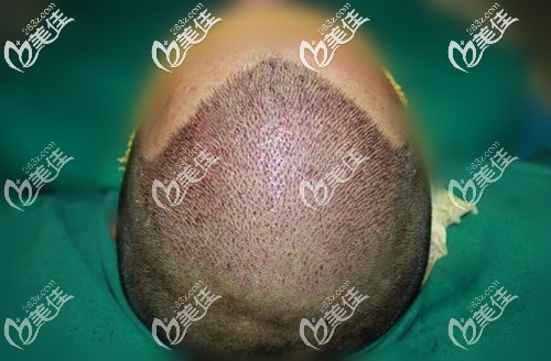 前額頭頂種植術(shù)后即刻效果 前額頭頂種植術(shù)后即刻效果