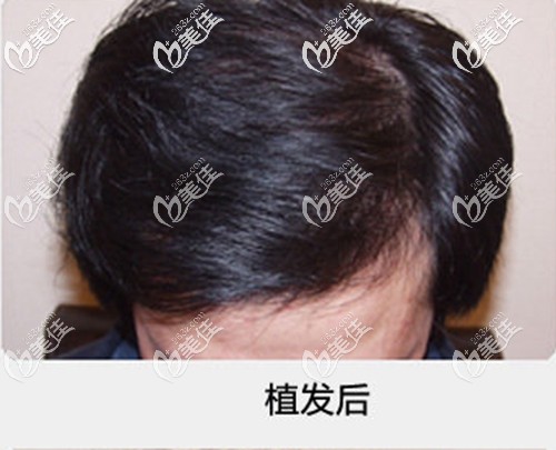 講述我去廣州壹加壹做頭頂植發(fā)的親身經(jīng)歷,花了三萬多的價(jià)格,效果怎樣你們來看!
