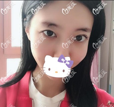 雙眼皮修復(fù)術(shù)前照 雙眼皮修復(fù)術(shù)前照