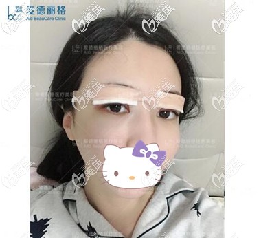 大連雙眼皮修復(fù)術(shù)后當天照 大連雙眼皮修復(fù)術(shù)后當天照