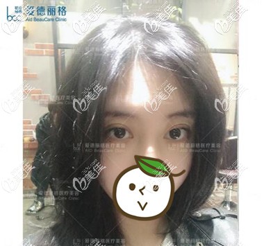 在大連修復(fù)雙眼皮術(shù)后第5天照 在大連修復(fù)雙眼皮術(shù)后第5天照