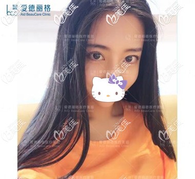 雙眼皮失敗修復(fù)術(shù)后半個月效果照 雙眼皮失敗修復(fù)術(shù)后半個月效果照