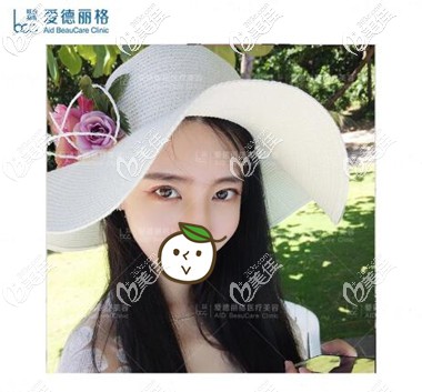 埋線雙眼皮失敗修復(fù)術(shù)后1個月照 埋線雙眼皮失敗修復(fù)術(shù)后1個月照