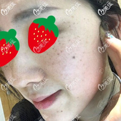 這是剛做完皮秒拍的照 這是剛做完皮秒拍的照