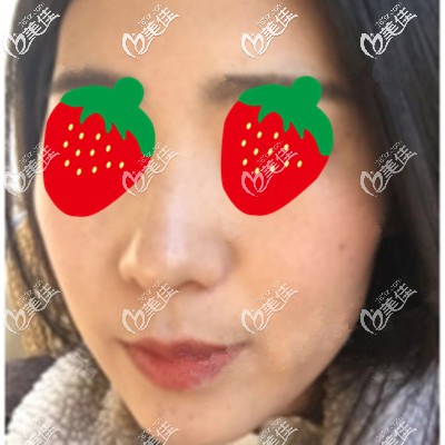 皮秒祛斑術(shù)后半個(gè)月照片 皮秒祛斑術(shù)后半個(gè)月照片