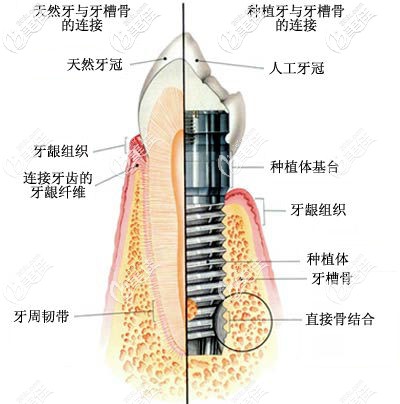 種植牙的結(jié)構(gòu)圖 種植牙的結(jié)構(gòu)圖