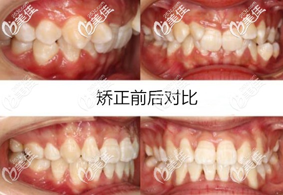 這是我一個26歲老阿姨在義烏傅氏口腔做深覆蓋牙齒矯正的案例哦，有沒有和我一樣矯正后像墊下巴的？