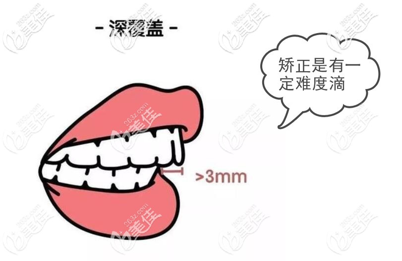 深覆蓋矯正難度大不大 深覆蓋矯正難度大不大