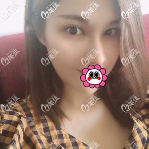 肋軟骨隆鼻恢復(fù)一個(gè)月<span style= 肋軟骨隆鼻恢復(fù)一個(gè)月<span style=