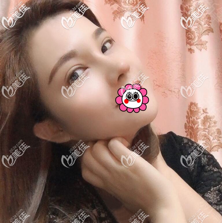 鼻子基礎(chǔ)比較差看我找寧波藝肖慶華做的肋軟骨隆鼻恢復(fù)兩個月的效果好嗎