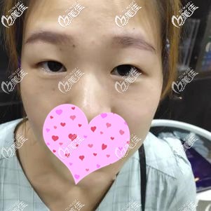 改善內(nèi)眥贅皮前的自己眼睛 改善內(nèi)眥贅皮前的自己眼睛