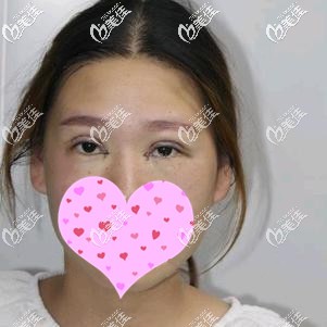 全切雙眼皮術(shù)后即刻未包扎 全切雙眼皮術(shù)后即刻未包扎