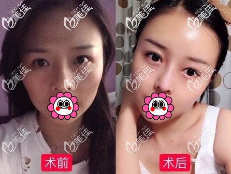 自體脂肪面部填充效果對比圖