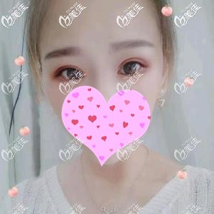 看過關(guān)于“眼角有內(nèi)眥贅皮適合做埋線雙眼皮嗎”的資料后，我還是決定做全切雙眼皮+開眼角改善