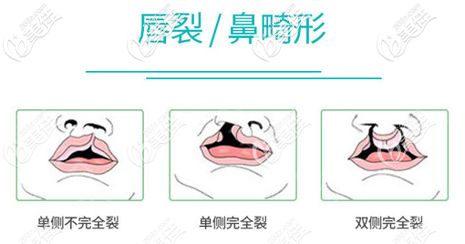 唇裂三種形態(tài)